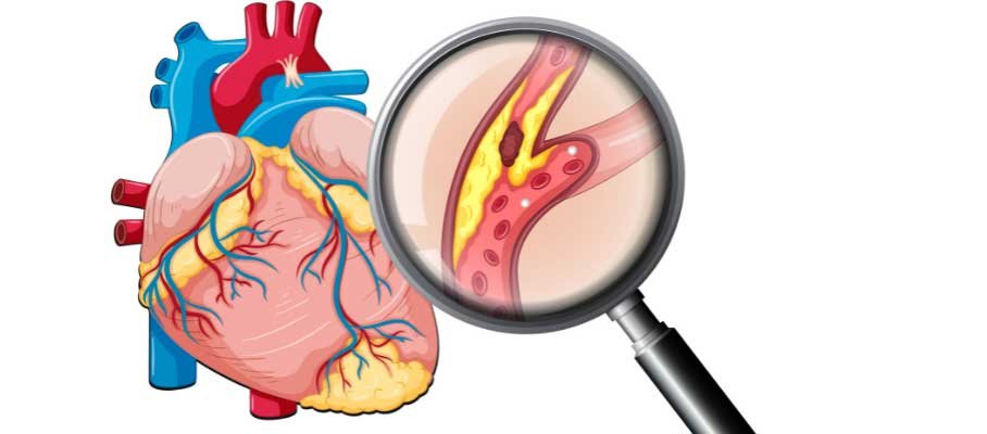 Hyperlipidemia Treatment